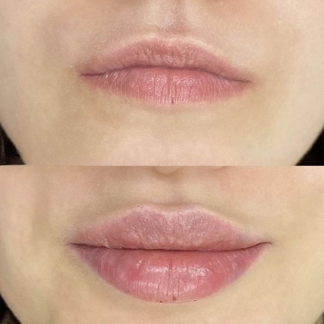 Maschera rimpolpante labbra al collagene